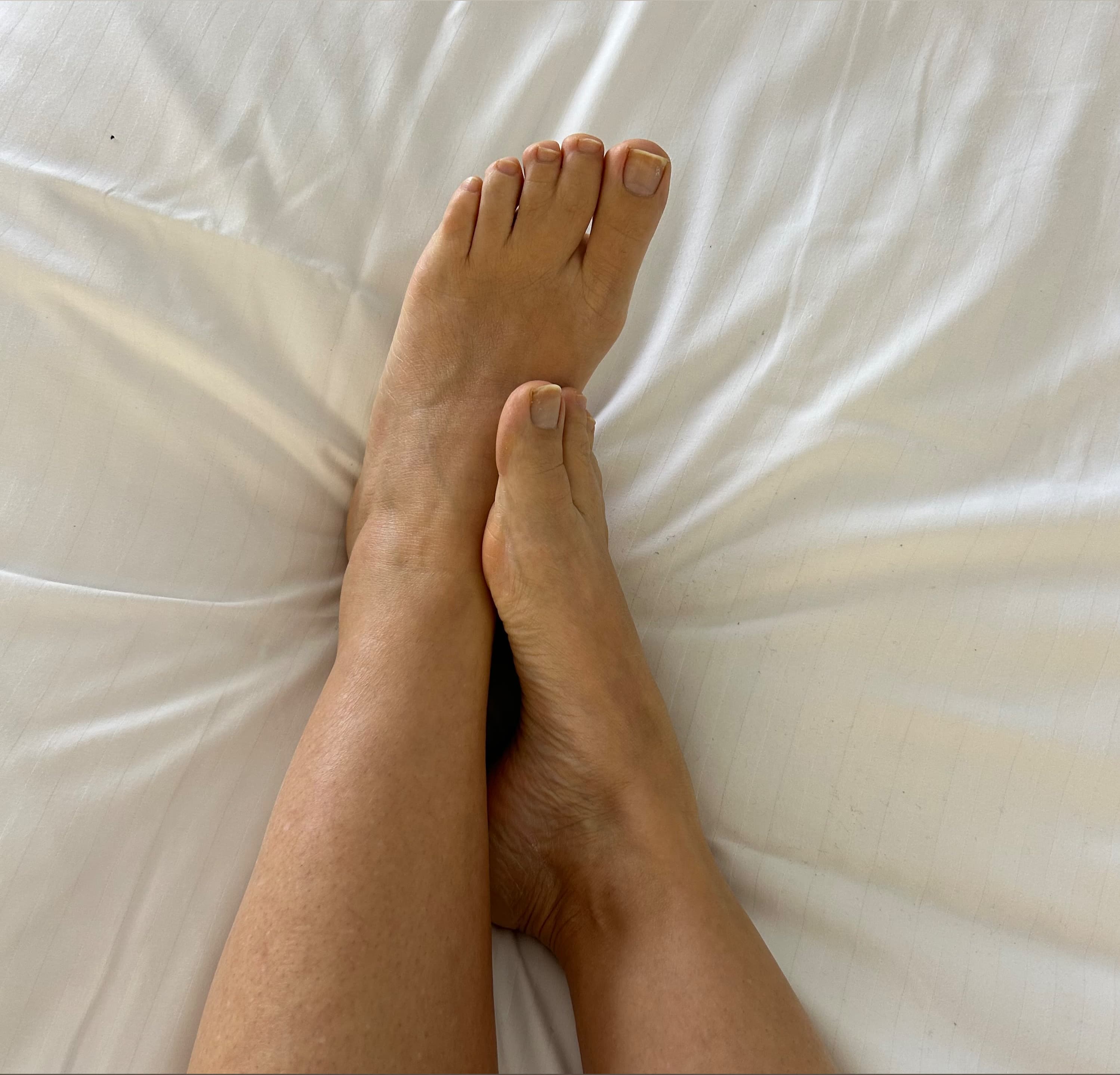 syndactyly.feet.treat banner image
